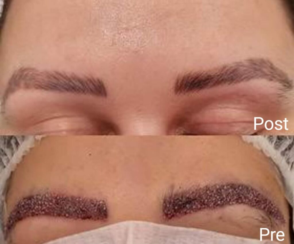 زراعة الحواجب قبل وبعد